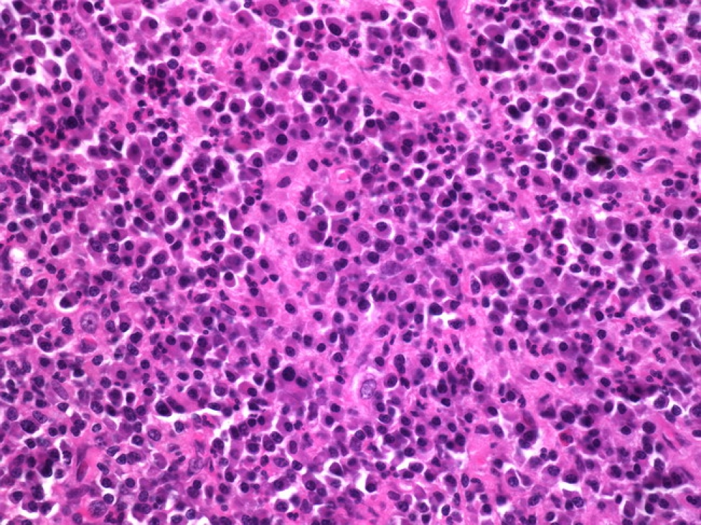 Фото Актиномикоза Молочной Железы — Mixyfotos.ru