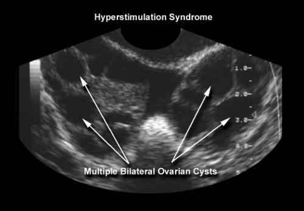 Стимуляция яичников. Гиперстимуляция яичников УЗИ. УЗИ яичников при гиперстимуляции. Синдром гиперстимуляции яичников.