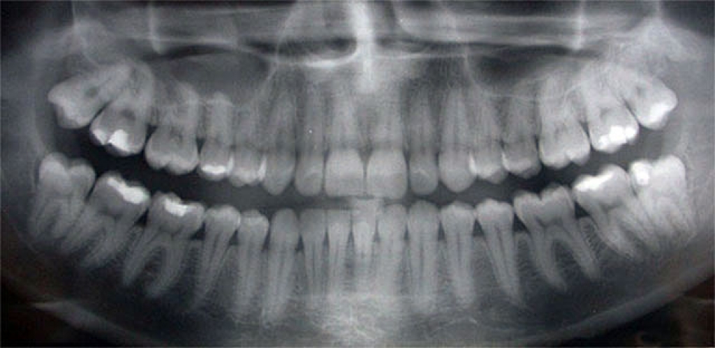 Как делают снимки зубов в стоматологии фото